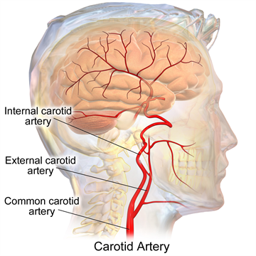 Carotid (1)